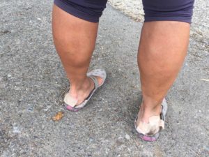 spain-camino-pilgrim-with-blistered-feet